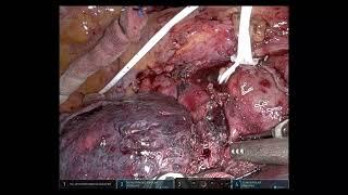 Cerfolio Surgery: Robotic RUL after Immunotherapy, with Proximal Control of the Main PA