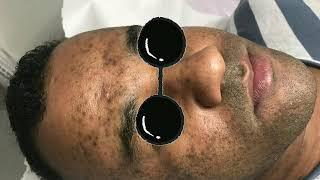 Tratamento de Manchas de Acne com Microagulhamento