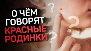 Что значат красные родинки на теле?