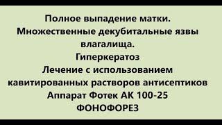 Декубитальные язвы влагалища при полном выпадении матки