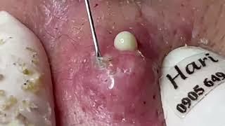 Blackheads/Pimples/Whiteheads Removal with Hari's -  Satisfying