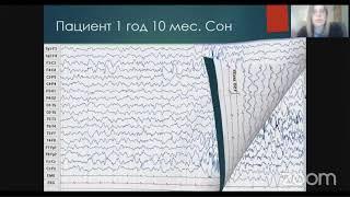 Физиологические ритмы и паттерны ЭЭГ у детей в возрасте от 1 мес до 7 лет. Романова АВ., Москва