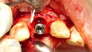 ISIII BY NEOBIOTECH IN A EXPLANTATION ANTERIOR ZONE