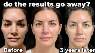 How Long does Sculptra Last? Sculptra Face Transformation Before and After