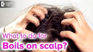 Boils On Scalp Filled With Pus.  Causes, Treatment - Dr. Rashmi Ravindra| Doctors' Circle