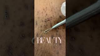 Ingrown Hair Removal Part 1