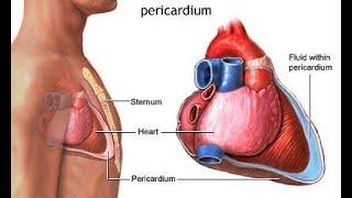 Cardiac Tamponade