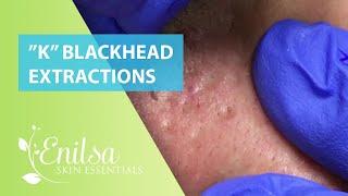 Blackheads Extractions “K’s” 3rd Treatment