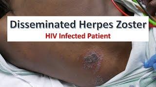 Disseminated Herpes Zoster Infection in an HIV Patient