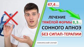 Лечение тяжёлой формы сонного апноэ без СИПАП-терапии | Разбор реального случая