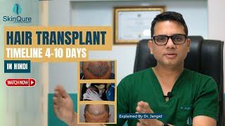 Hair Transplant Timeline 4 -10th day | Best Dermatologist and Hair Transplant Surgeon in Delhi