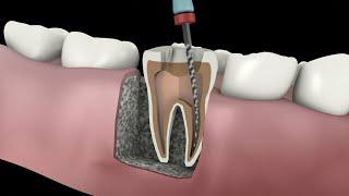 root canal procedure #shorts