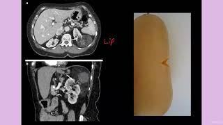 tkr_HTP_05 ANGIOMYOLIPOMA HOW TO APPROACH ON IMAGING with classic signs AND FOLLOW UP