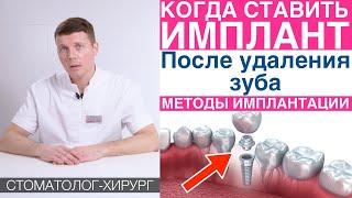 Когда устанавливать зубной имплант после удаления зуба? Методики имплантации зубов.