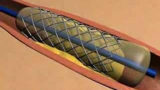 Stent Animation