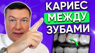 Как лечат кариес МЕЖДУ зубами? ЛЕЧЕНИЕ кариеса между зубами.