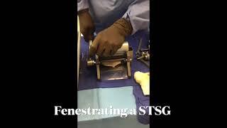 Fenestrating a Splint Thickness Skin Graft