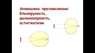 Аномалии преломления: близорукость, дальнозоркость, астигматизм