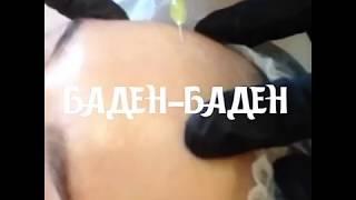 Плазмолифтинг в центре "Баден-Баден", Москва.