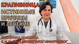 Крапивница, настоящие причины и лечение. Врач аллерголог иммунолог Екатерина Цывкина.