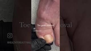 Toe gunk removal *satisfying* #deadskin #pedicure #satisfyingvideo #toenails #cleannails