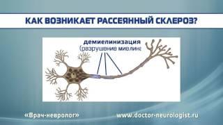 Рассеянный склероз: причины возникновения, клинические признаки