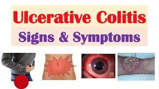 Ulcerative Colitis Signs and Symptoms (& Why They Occur), and Complications