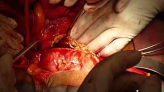 Aortic Aneurysm.wmv