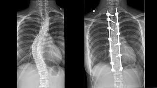 Лечение сколиоза и кифоза | Искривление позвоночника у детей
