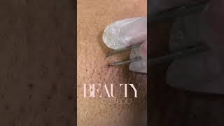 Ingrown Hair Removal