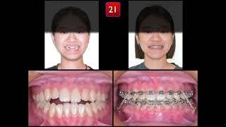 Solving Class III Malocclusion with Anterior Openbite by Damon Q2｜【Chris Chang Ortho】CC801