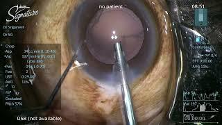 Surgical Performance of Quatera700 Versus Centurion and Signature Pro – Video S3 [456660]