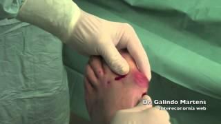 Cirurgia Percutâne Hallux Valgo