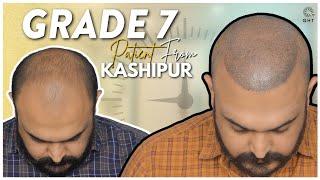 Best Hair Transplant In India | Surgery Experience | Grade 7 | QHT Clinic Haridwar