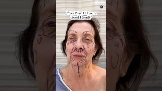 Natural Results| Facelift 2 Months Post-Op| Before and After