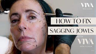 HOW TO FIX SAGGING JOWLS | DERMAL FILLER INJECTIONS VIVA 2023