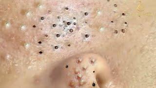 Remove Blackheads and Pimples Popping At HT Spa #31