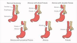 Esophageal Atresia - What is Esophageal Atresia