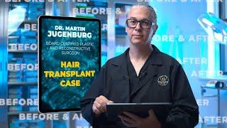 Patient Case with Dr. 6ix: 3000 Grafts | Nova Medical Hair Transplant Clinic