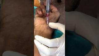 ABG technique Radial artery  #norcet #nursing #knowledge #medical #abg