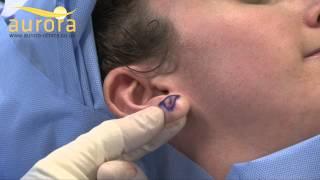 Stretched earlobe repair - Aurora Clinics