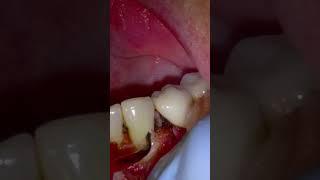 Filling On A Cavity Due To External Resorption! Small Surgery To Fill the Tooth.