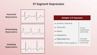 Intro to EKG Interpretation - QRST Changes