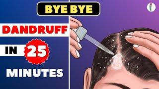 #1 Dandruff Treatment at Home | How to get rid of Dandruff | Dandruff Removal | Itchy scalp