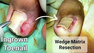 Ingrown toenail | Wedge Matrix Resection | Video Based Learning - Dr Tayyab Riaz Ch