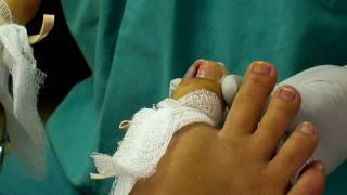 Ingrown Toenail Removal