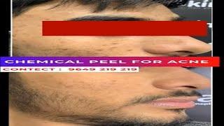 Why You Really Need CHEMICAL PEEL FOR ACNE. #chemical_peel #chemicalpeel #shorts #creatingforindia