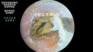 采耳哥-Clean dry fungal slices in the ear ｜566 #asmr #earwax #earwaxremoval #drzhao