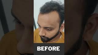 Hair transplant in gwalior | Amazing Hair transplant result #shorts #shortsfeed #viral #amazing