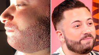 Beard transplantation in summer: Now is the perfect moment